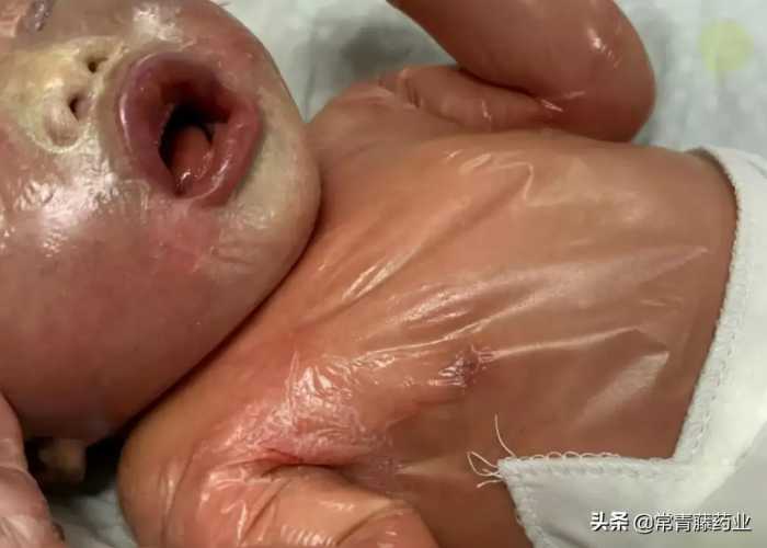 罕见火胶棉样婴儿被成功救治，此病有多恐怖？只有10%可恢复正常